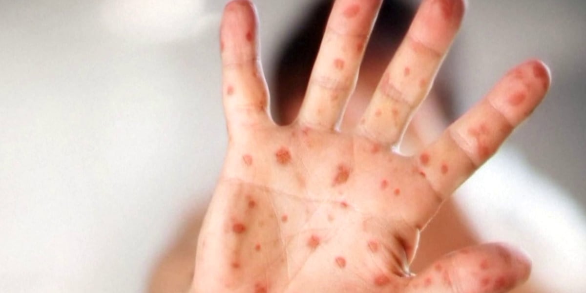 Missouri confirmed measles cases Missouri confirmed measles cases